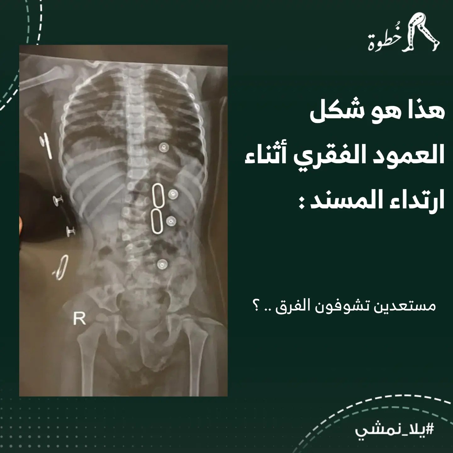  تقويم العمود الفقري1 